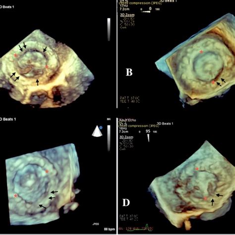 In Patients With A Sorin Bicarbon Mitral Bileaflet Prosthetic Valve A