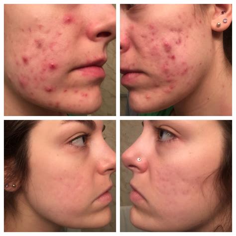 Before and after Accutane (6 months) : acne