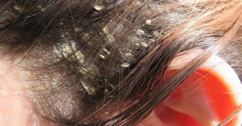 Dandruff and scalp psoriasis are two common scalp issues. Scalp eczema: Symptoms, treatment, and remedies