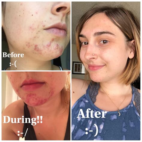 Before And After Using Retin A Tretinoin 0025 Never Ending Journey