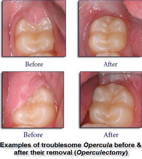Operculectomy Pic Dental Health Stop