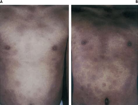 Figure 1 From Fixed Drug Eruption Presenting As Erythema Dyschromicum