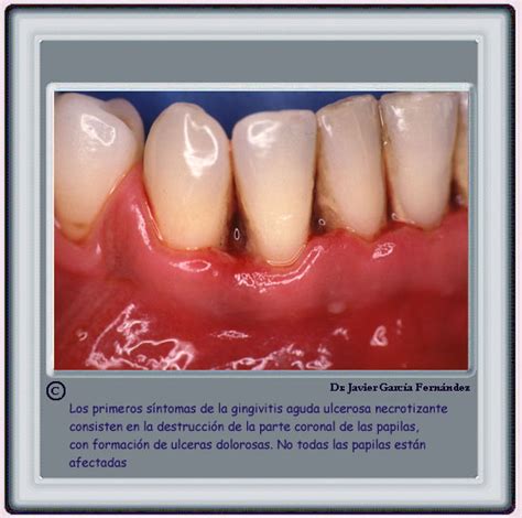 Gingivitis Ulcerosa Necrotizante Estomatitis Ulcerosa Boca De