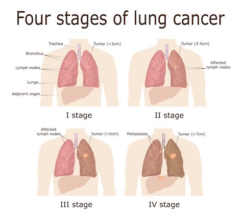 Lung cancer, also known as lung carcinoma, is a malignant lung tumor characterized by uncontrolled cell growth in tissues of the lung. Lung Cancer Symptoms, Risk Factors, Diagnosis, and ...