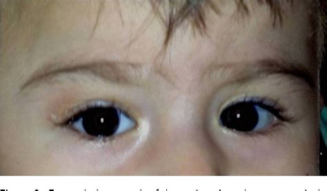Figure 3 From An Unusual Eyelid Mass Tarsal Dermoid Cyst Semantic