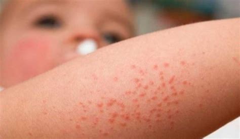 Dermatitis Atópica En Niños ¿qué Es Síntomas Y Tratamientos