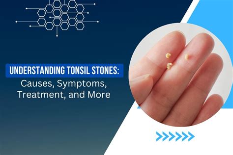 Understanding Tonsil Stones Causes Symptoms Treatment And More By