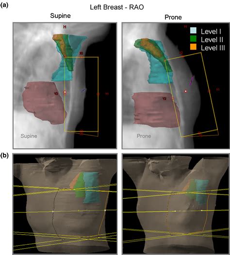 Coverage Of Axillary Lymph Nodes In Supine Vs Prone Breast