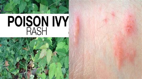 Poison Oak Rash Signs Symptoms Causes And Prevention