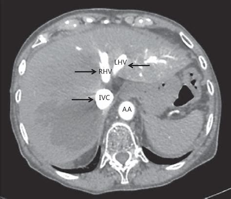 High Resolution Ct Of The Abdomen Axial Image In A Patient With Net