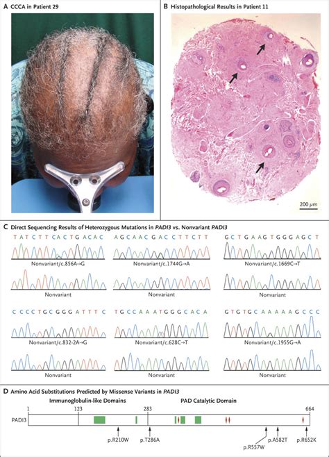 Variant Padi3 In Central Centrifugal Cicatricial Alopecia Nejm