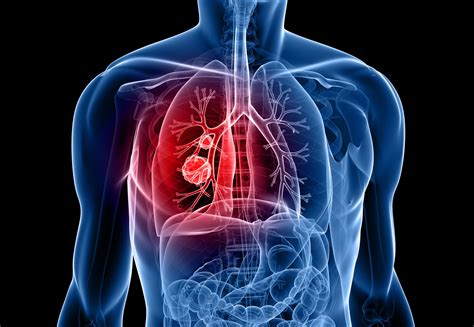 Life Extending Drug For Chronic Lung Disease Available On The Nhs Uk