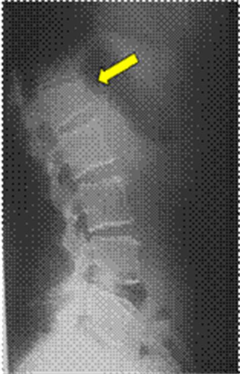 OSTEOPOROSI.ch: Diagnosi osteoporosi radiologia