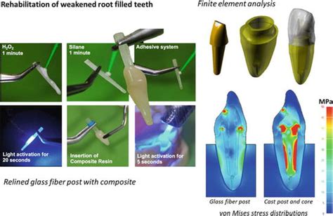 Fiber posts simplify the endodontic restoration procedure compared to the use of metal cast posts by eliminating the laboratory step. Biomechanical Principles of Root Canal-Treated-Teeth ...