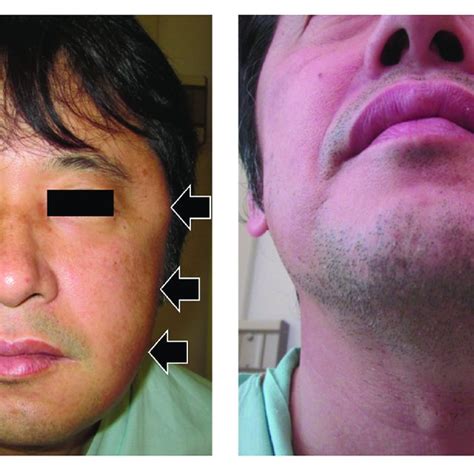 Pdf Proliferative Fasciitismyositis Involving The Facial Muscles