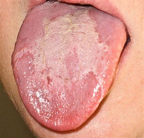 Swollen Tongue: An Awkward and Sometimes Dangerous Disorder - YouMeMindBody