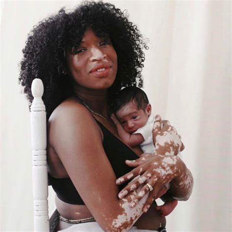What Its Really Like To Live With Vitiligo