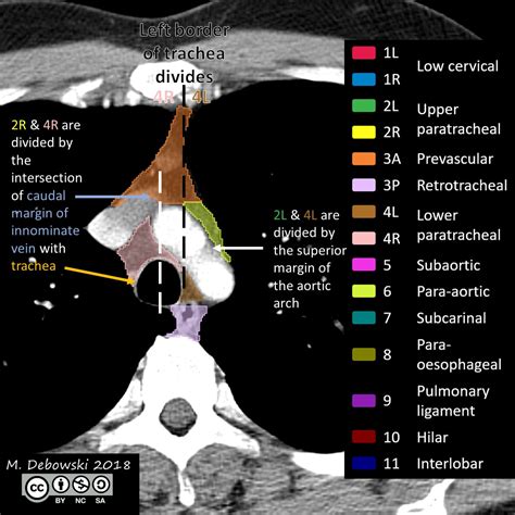 Thoracic Lymph Node Stations Annotated Ct Image