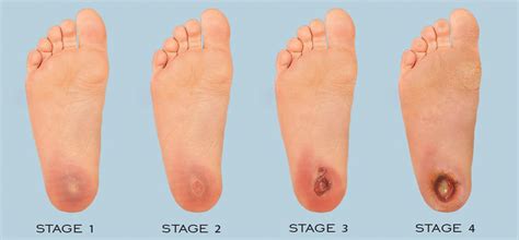 Diabetic foot ulcer and infection classification systems. Diabetic Foot Ulceration - Quality Foot Care
