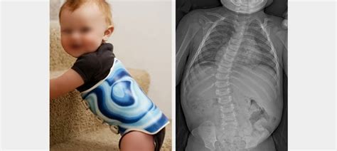 Infantile Scoliosis Learn Types And Treatment Options