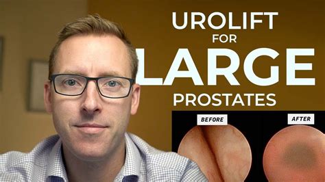 Urolift For A LARGE Prostate G YouTube