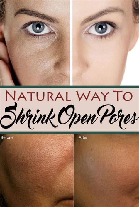Try These Natural Remedies To Shrink Open Pore On Your Face Surreal