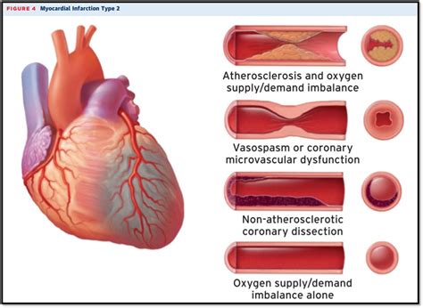 Criteria For Coronary Procedure Related Myocardial Infarction Types 4