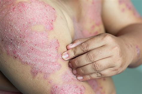 eczema vs psoriasis what you need to know ceradan advanced