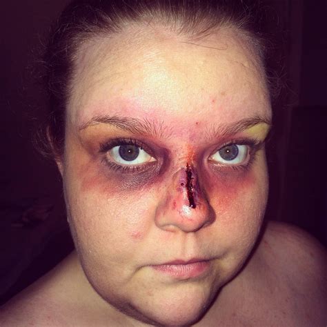 We did not find results for: Broken Nose/Bruising | Broken nose, Nostril hoop ring, Nose