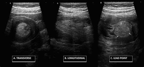 Cureus Ileal Lipoma As A Leading Point Of Ileocolic Intussusception In Adult Patient