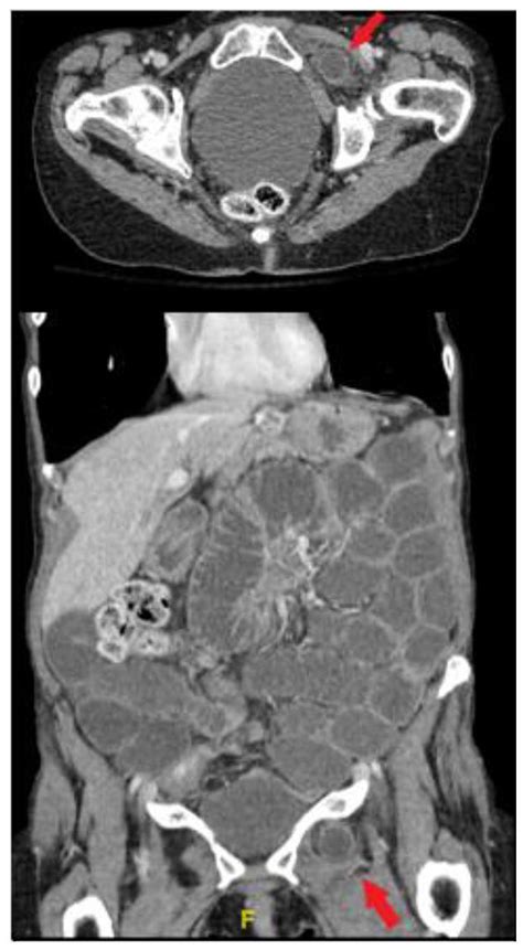 Rare Case Of Obturator Hernia Surgical Anatomy Planning And