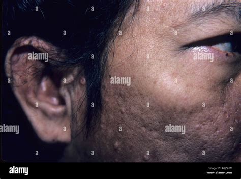 Acne Vulgaris On Patients Face Oily Seborrhea Severe Stock Photo Alamy