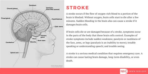 Stroke Definition And Symptoms A Graphic Depicting The Parts Flickr