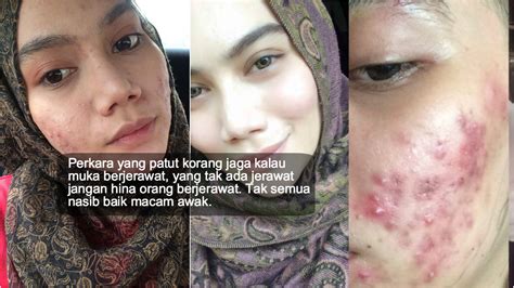 Dulu Muka Berjerawat And Rosak Teruk Gadis Ini Kongsi Perkara Penting