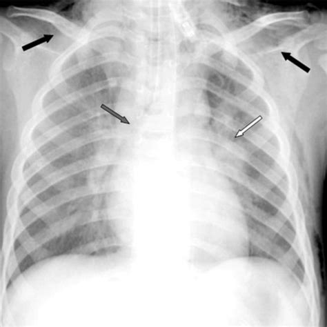 Chest X Ray Showing A Significant Enlargement Of The Left Lung Hilum