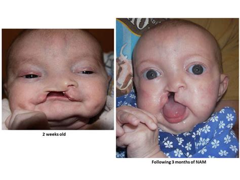 Your child may have clear liquids up to 2 hours before surgery. Cleft Lip Before and After Photo Gallery | Tufts Children ...