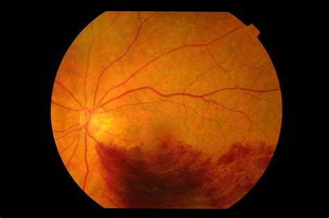 Retinal Vein Occlusion — Strathfield Retina Clinic