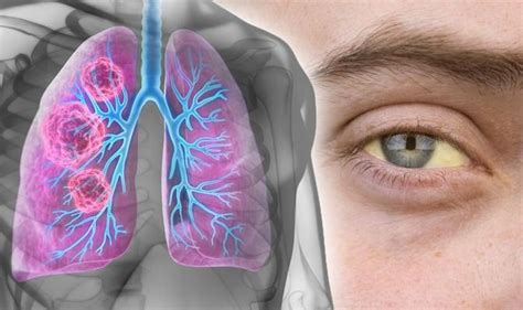 Lung Cancer Symptoms Signs Of A Tumour Include Yellow Eyes And Jaundice Express Co Uk
