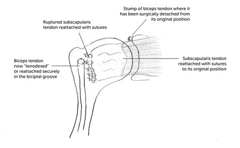 Subscapularis Repair Dr David Duckworth