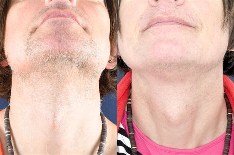 Before And After Electrolysis Hair Removal Neelishroman