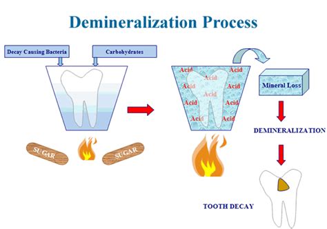 Dental Caries Process
