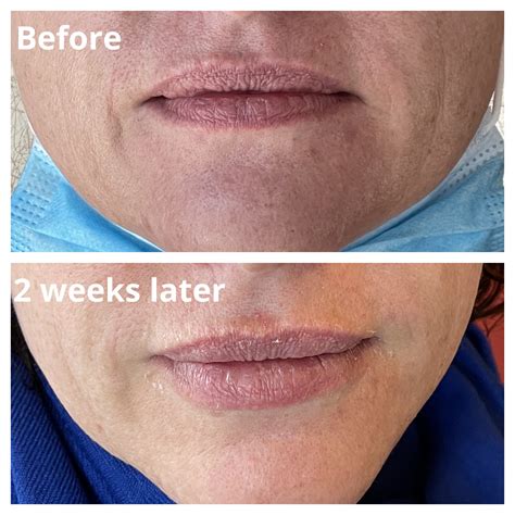 Kiss and Tell: Unmasking the Potential Risks of Lip Fillers – Dermis