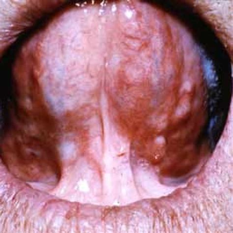 T2 Squamous Cell Carcinoma On The Ventral Tongue Download Scientific