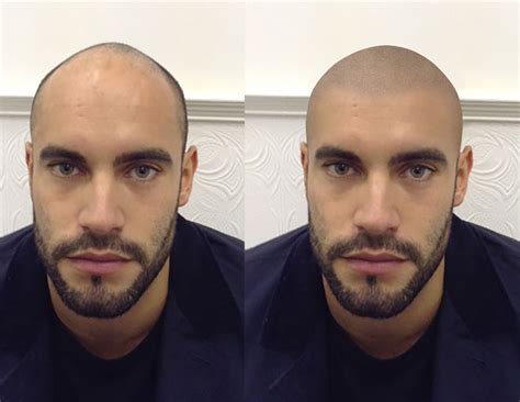 Scalp Micro Pigmentation is hot at the moment. Over a very ...