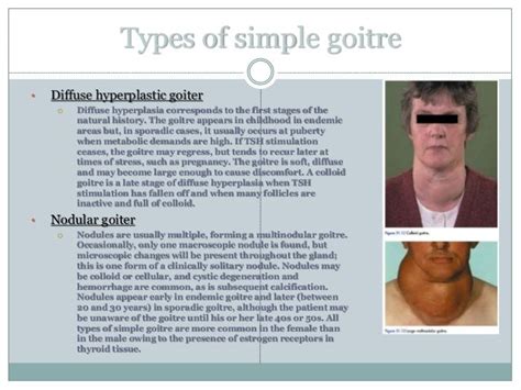 2 Classification Of Goitre