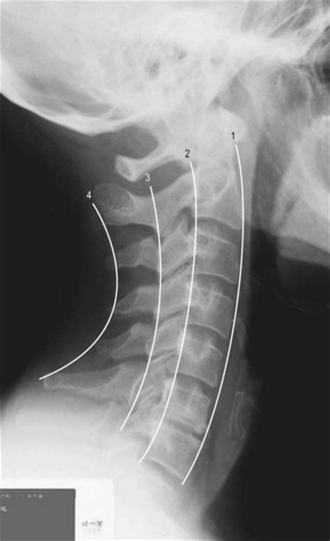 Cervical Spine Radiology Key