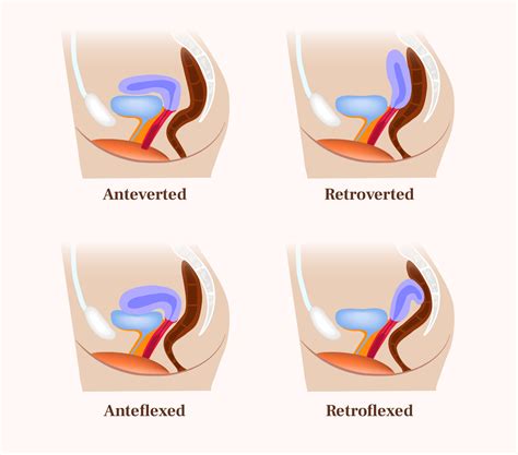 retroverted uterus cervix position