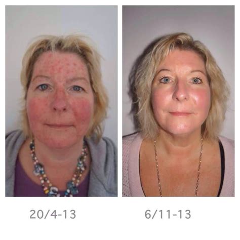 You can jump start your skin's renewal process while you sleep by using an intensely hydrating night recovery cream. Nuskin skin care before and after | Hautpflegeprodukte ...