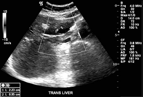 Hepatic Cyst On Ultrasound Radrounds Radiology Network