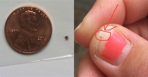 Moms Scary Facebook Post Warns Parents About Disease Carrying Seed Ticks